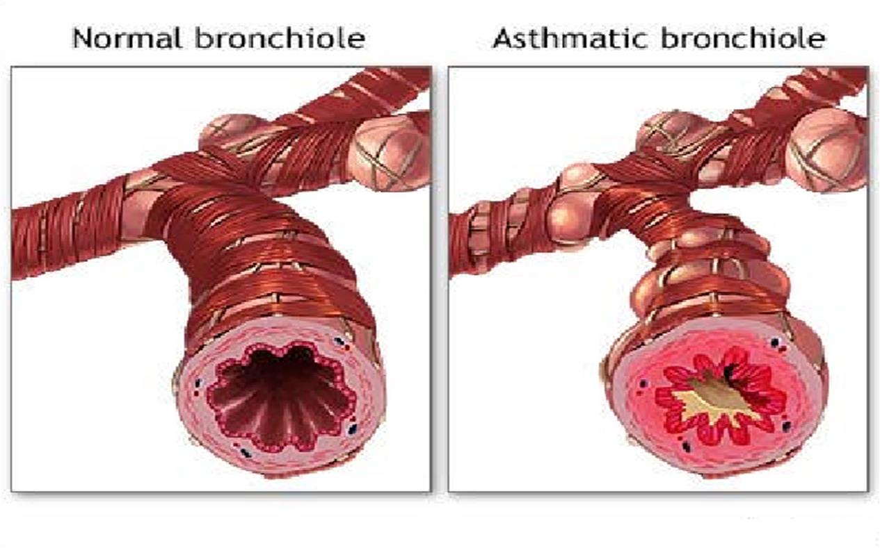 Bronchial Asthma