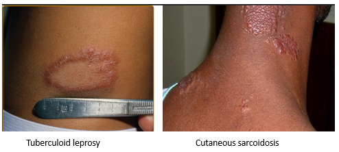 Differential Diagnosis of Leprosy
