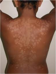 Differential Diagnosis of Leprosy
