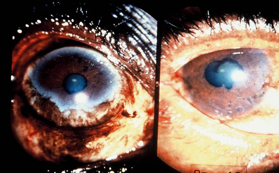 Infectious Eye Diseases: Leprosy, Trachoma and Onchocerciasis