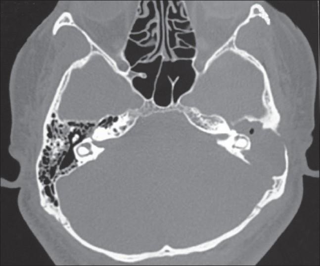 Chronic Suppurative Otitis Media