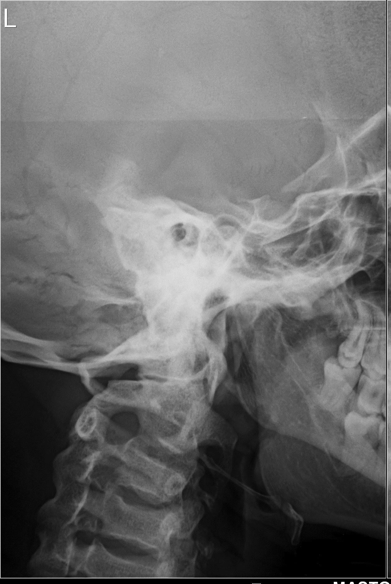 Chronic Suppurative Otitis Media