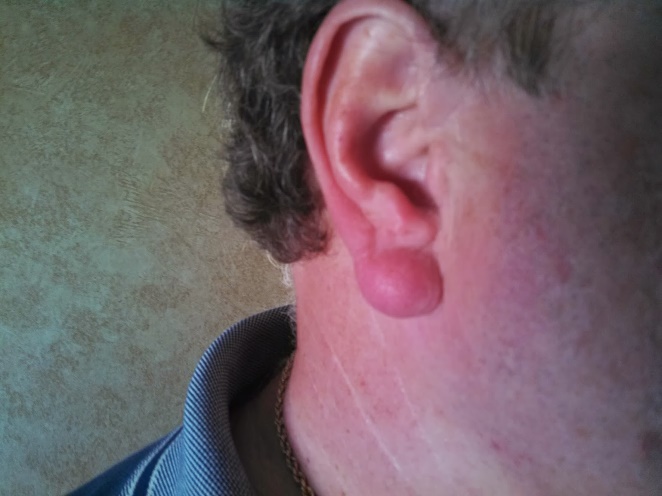 Common Diseases of the Pinna and External Auditory Canal