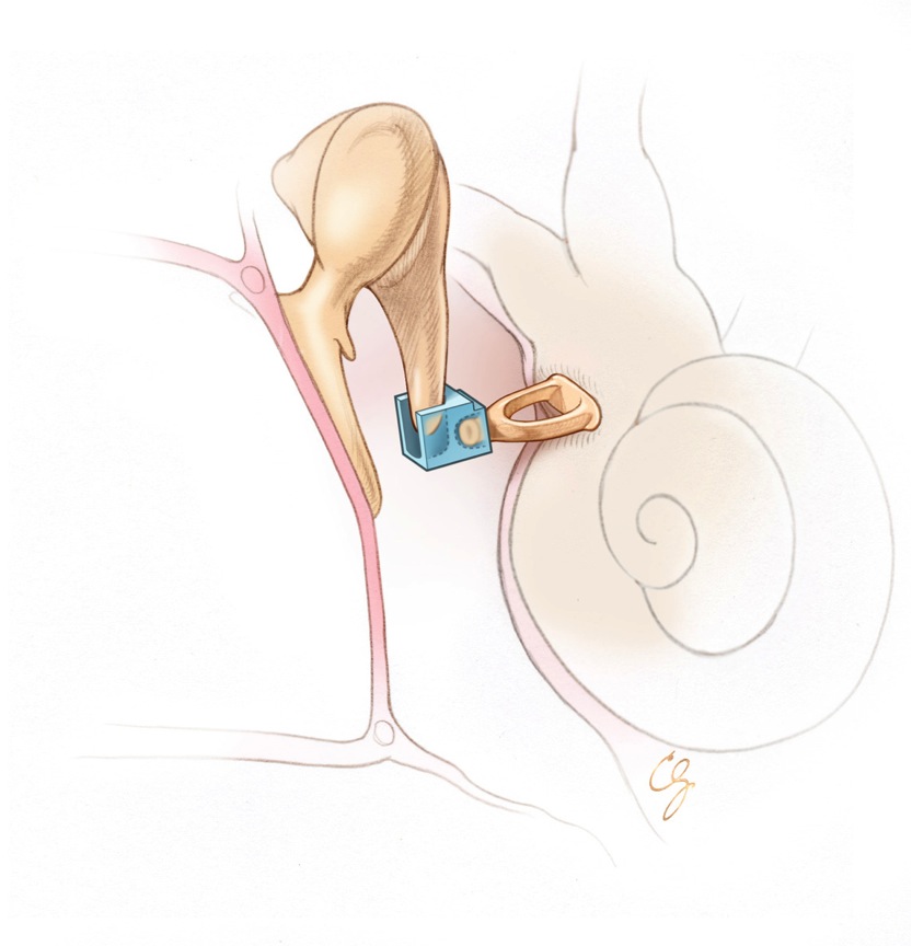 External and Middle Ear Surgery