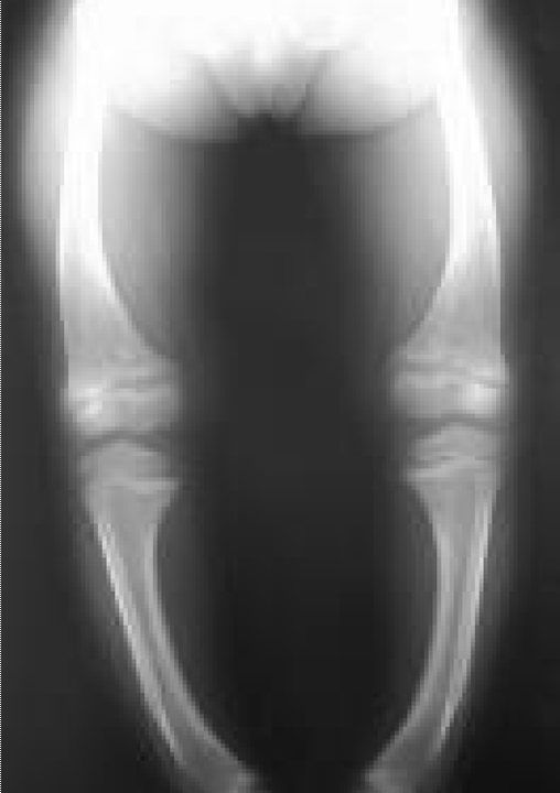 Rickets