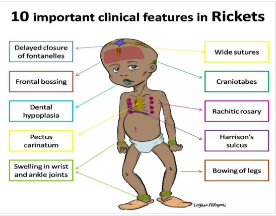 Rickets